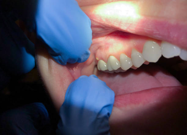 Best Emergency Gum Treatment in Fruitville, FL